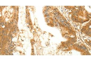 Immunohistochemistry of paraffin-embedded Human colon cancer tissue using RARRES1 Polyclonal Antibody at dilution 1:60 (RARRES1 antibody)