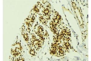 ABIN6277754 at 1/100 staining Human breast cancer tissue by IHC-P. (GLI2 antibody  (N-Term))