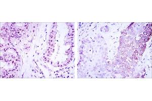 Immunohistochemical analysis of paraffin-embedded lung cancer (left) and esophagus cancer (right) using CRTC3 mouse mAb with DAB staining. (CRTC3 antibody)