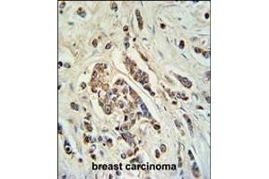 ABCC11 Antibody (N-term) (ABIN650984 and ABIN2840023) IHC analysis in formalin fixed and paraffin embedded breast carcinoma followed by peroxidase conjugation of the secondary antibody and DAB staining. (ABCC11 antibody  (N-Term))