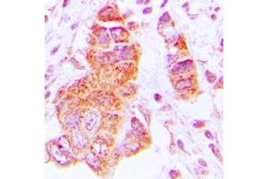 Immunohistochemical analysis of CK1 epsilon staining in human lung cancer formalin fixed paraffin embedded tissue section.