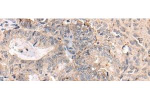 Immunohistochemistry of paraffin-embedded Human ovarian cancer tissue using MEDAG Polyclonal Antibody at dilution of 1:75(x200) (MEDAG antibody)