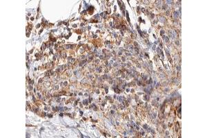 ABIN6266858 at 1/100 staining human Breast cancer tissue sections by IHC-P. (BCAR3 antibody  (C-Term))