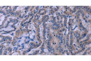 Immunohistochemistry of paraffin-embedded Human thyroid cancer tissue using TUBGCP2 Polyclonal Antibody at dilution 1:50 (TUBGCP2 antibody)