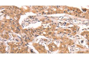 Immunohistochemistry of paraffin-embedded Human lung cancer using AASDHPPT Polyclonal Antibody at dilution of 1:30 (AASDHPPT antibody)