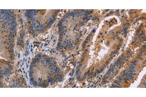 Immunohistochemistry of paraffin-embedded Human colon cancer tissue using FAAH2 Polyclonal Antibody at dilution 1:30 (FAAH2 antibody)