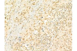 ABIN7094501 and ABIN7098550 at 1/100 staining Human liver cancer by IHC-P. (PRDM16 antibody  (Internal Region))