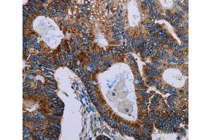 Immunohistochemistry of Human colon cancer using F11R Polyclonal Antibody at dilution of 1:40