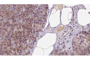 ABIN6273253 at 1/100 staining Human pancreas cancer tissue by IHC-P. (GSTM4 antibody  (Internal Region))