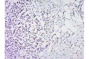 Paraformaldehyde-fixed, paraffin embedded Human Cervical cancer Antigen retrieval by boiling in sodium citrate buffer (pH6. (HOXC8 antibody  (AA 51-130))