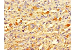 Immunohistochemistry of paraffin-embedded human melanoma using ABIN7172677 at dilution of 1:100 (TAF13 antibody  (AA 1-124))