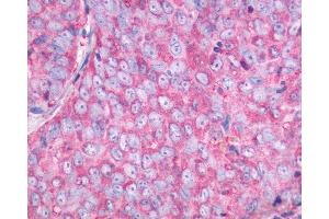 Anti-NMBR antibody IHC of human Ovary, Carcinoma. (NMBR antibody  (C-Term))
