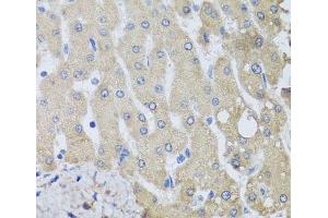 Immunohistochemistry of paraffin-embedded Human liver damage using NSF Polyclonal Antibody at dilution of 1:100 (40x lens). (NSF antibody)