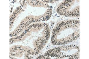Immunohistochemistry of Human lung cancer using HNF1B Polyclonal Antibody at dilution of 1:80