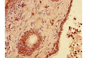 Immunohistochemistry of paraffin-embedded human prostate cancer using ABIN7174316 at dilution of 1:100 (USP33 antibody  (C-Term))