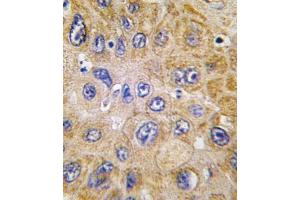 Formalin-fixed and paraffin-embedded human hepatocarcinoma tissue reacted with THY1 antibody (N-term) (ABIN388803 and ABIN2839126) , which was peroxidase-conjugated to the secondary antibody, followed by DAB staining. (CD90 antibody  (N-Term))