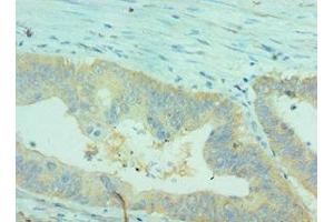 Immunohistochemistry of paraffin-embedded human colon cancer using ABIN7147898 at dilution of 1:100 (Claudin 2 antibody  (AA 30-230))