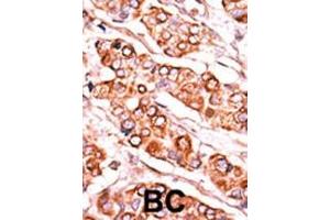 Formalin-fixed and paraffin-embedded human cancer tissue reacted with the primary antibody, which was peroxidase-conjugated to the secondary antibody, followed by DAB staining. (PDXK antibody  (C-Term))