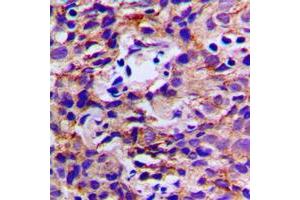 Immunohistochemical analysis of DDX3Y staining in human breast cancer formalin fixed paraffin embedded tissue section. (DDX3Y antibody  (N-Term))