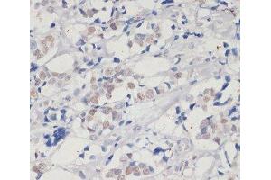 Immunohistochemistry of paraffin-embedded Human breast cancer using DNMT1 Polyclonal Antibody at dilution of 1:200 (40x lens). (DNMT1 antibody)