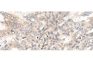 Immunohistochemistry of paraffin-embedded Human liver cancer tissue using CHRD Polyclonal Antibody at dilution of 1:40(x200) (Chordin antibody)