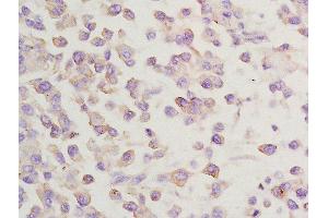 Formalin-fixed and paraffin embedded rat lung carcinoma labeled with Anti-GGA2 Polyclonal Antibody, Unconjugated  at 1:200 followed by conjugation to the secondary antibody and DAB staining (GGA2 antibody  (AA 161-260))