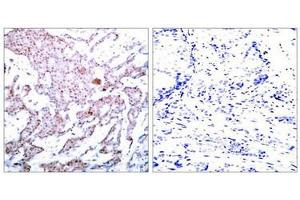 Immunohistochemical analysis of paraffin-embedded human breast carcinoma tissue using NFκB-p65 (Phospho-Ser536) Antibody (left) or the same antibody preincubated with blocking peptide (right). (NF-kB p65 antibody  (pSer536))