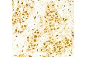 Immunohistochemistry of paraffin embedded human colon cancer using EFTUD2 (ABIN7073810) at dilution of 1: 2400 (400x lens)