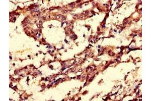 Immunohistochemistry of paraffin-embedded human gastric cancer using ABIN7148838 at dilution of 1:100 (Cyclin C antibody  (AA 240-283))