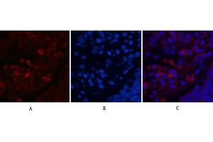 Immunofluorescence analysis of human lung cancer tissue. (MAP1LC3A antibody)