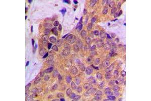 Immunohistochemical analysis of Cortactin (pY421) staining in human breast cancer formalin fixed paraffin embedded tissue section.