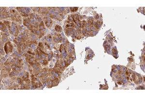 ABIN6277647 at 1/100 staining Human liver cancer tissue by IHC-P.