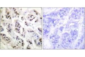 Immunohistochemistry analysis of paraffin-embedded human breast carcinoma tissue, using Lamin A/C (Ab-392) Antibody. (Lamin A/C antibody  (AA 361-410))