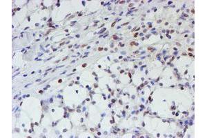 Immunohistochemical staining of paraffin-embedded Carcinoma of Human kidney tissue using anti-MLF1 mouse monoclonal antibody. (MLF1 antibody)