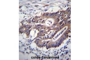 KRT12 Antibdy (C-term) immunohistochemistry analysis in formalin fixed and paraffin embedded human colon carcinoma followed by peroxidase conjugation of the secondary antibody and DAB staining. (KRT12 antibody  (C-Term))