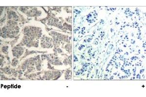 Immunohistochemical analysis of paraffin-embedded human breast carcinoma tissue using CFL1/CFL2 polyclonal antibody . (Cofilin antibody  (Tyr88))
