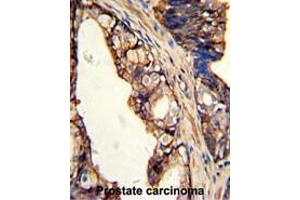 Formalin-fixed and paraffin-embedded human prostate carcinoma with TGM4 Antibody (Center), which was peroxidase-conjugated to the secondary antibody, followed by DAB staining. (TGM4 antibody  (Middle Region))