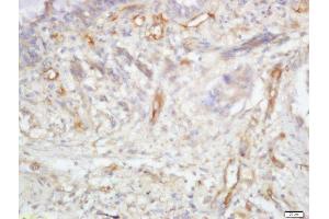 Formalin-fixed and paraffin embedded human lung cancer labeled with Anti-TRIB2 Polyclonal Antibody, Unconjugated  at 1:200 followed by conjugation to the secondary antibody and DAB staining (TRIB2 antibody  (AA 151-250))