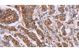 Immunohistochemistry of paraffin-embedded Human breast cancer tissue using DCTN6 Polyclonal Antibody at dilution 1:40 (DCTN6 antibody)