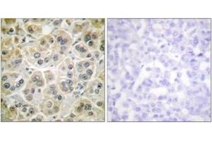 Immunohistochemistry analysis of paraffin-embedded human breast carcinoma tissue, using Vimentin Antibody.
