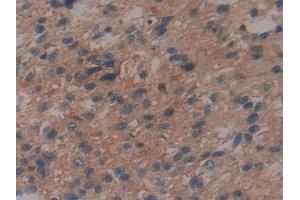 DAB staining on IHC-P; Samples: Human Glioma Tissue (IL29 antibody  (AA 20-200))