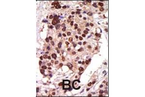Formalin-fixed and paraffin-embedded human cancer tissue reacted with the primary antibody, which was peroxidase-conjugated to the secondary antibody, followed by AEC staining. (PRKD3 antibody  (AA 352-384))