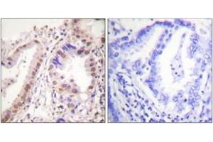 Immunohistochemistry analysis of paraffin-embedded human lung carcinoma tissue, using Estrogen Receptor-alpha (Ab-537) Antibody.