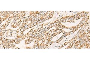 Immunohistochemistry of paraffin-embedded Human liver cancer tissue using COX6C Polyclonal Antibody at dilution of 1:25(x200) (COX6C antibody)