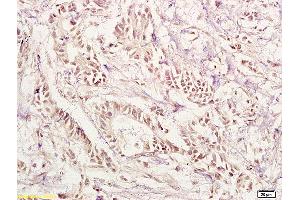 Formalin-fixed and paraffin embedded human gastric carcinoma labeled with Anti-PAX1 Polyclonal Antibody, Unconjugated (ABIN673269) at 1:200 followed by conjugation to the secondary antibody and DAB staining. (PAX1 antibody  (AA 151-250))