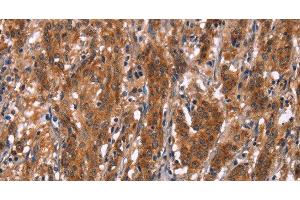 Immunohistochemistry of paraffin-embedded Human gastric cancer tissue using GPHN Polyclonal Antibody at dilution 1:30