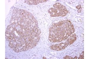 IHC-P Image tPA antibody detects tPA protein at cytoplasm on human colon carcinoma by immunohistochemical analysis. (PLAT antibody)