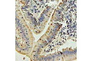 Immunohistochemical analysis of IL-27 staining in human colon cancer formalin fixed paraffin embedded tissue section. (IL-27 antibody)