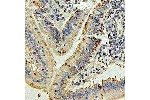 Immunohistochemical analysis of IL-27 staining in human colon cancer formalin fixed paraffin embedded tissue section.