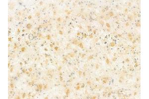 Ephrin B1/B2/B3 Antibody at 1/100 staining human astrocytoma by IHC-P. (Ephrin B1/B2/B3 (EFNB1/2/3) antibody)